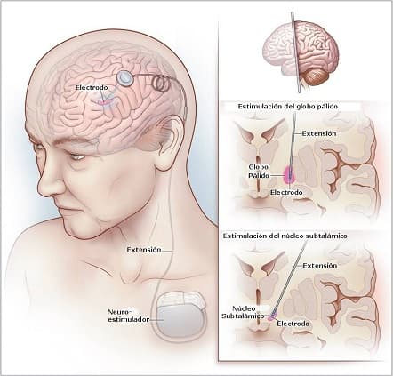 Imagen: Parkinson Galicia.