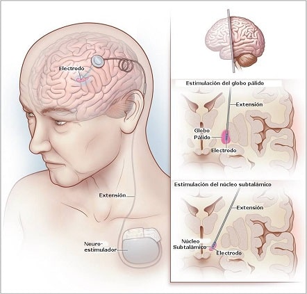 Imagen: Parkinson Galicia.