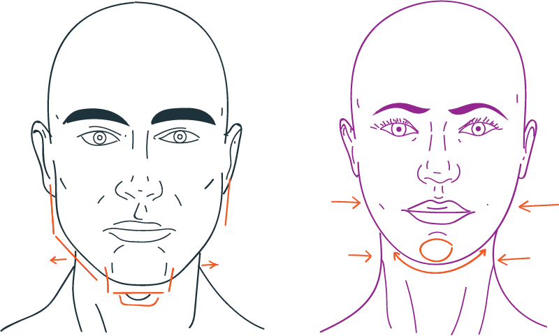 Aseguradora de salud no tiene que reembolsar cirugía facial a mujer transgénero, por cuanto antes de la operación era reconocida como mujer por terceros, resuelve un Tribunal de Países Bajos.