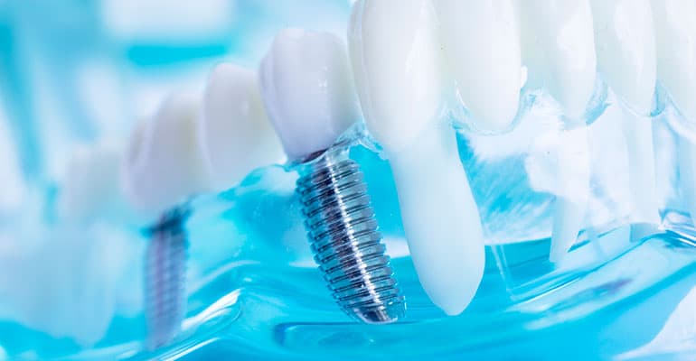 Corte Suprema declara inadmisible recurso de casación en Caso de Implantes Dentales Negligentes.